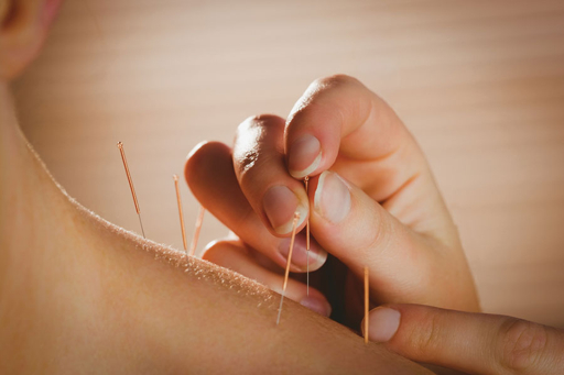 5 Best Acupuncturists in Bristol - Explore practitioners and options for pain care